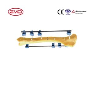 Bilateral External Fixator
