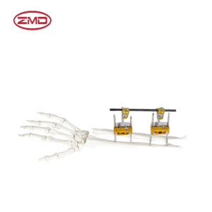 Combined Ulna and Radius External Fixator