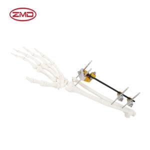 Combined Ulna and Radius External Fixator