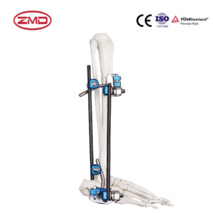 Combined Ankle Joint Fusion External Fixator